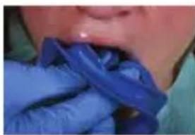 PHILIPS Zoom WhiteSpeed - In-office whitening treatment - 1