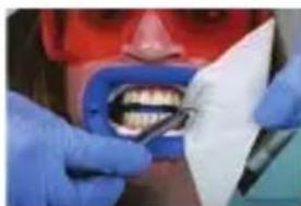 PHILIPS Zoom WhiteSpeed - In-office whitening treatment - 4