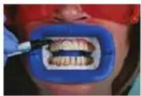 PHILIPS Zoom WhiteSpeed - In-office whitening treatment - 6