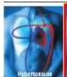 MICROLIFE IR 120 - 1