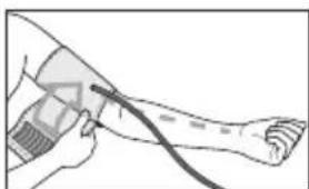 SANITAS SBM 18 - Applicazione del manicotto - 2