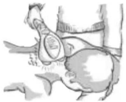 MEDISANA ITM 88275 - Aplicación - 2