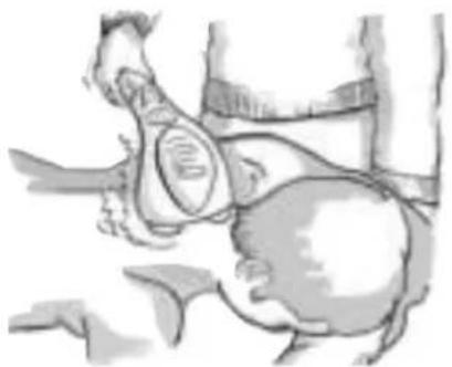 MEDISANA ITM 88275 - Aplicacao - 1