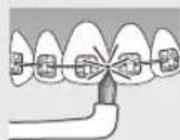 PANASONIC EWDP52 - Misaligned teeth Braces - 2