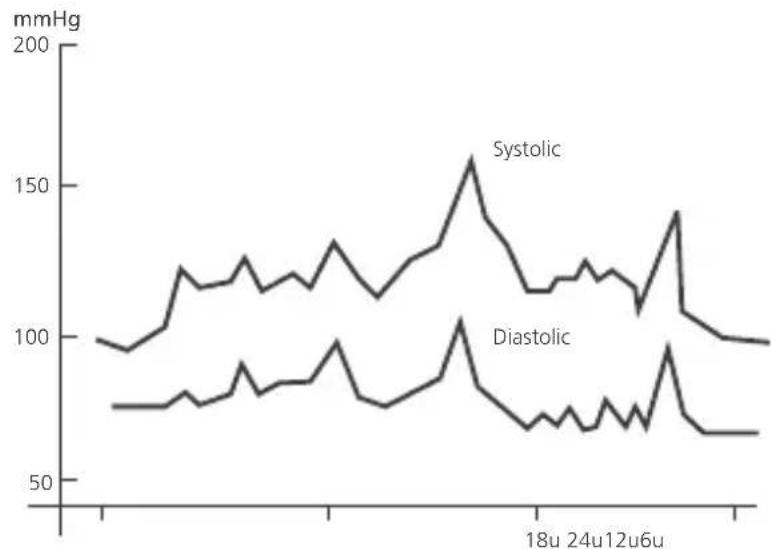 Levita BPM ARM 6331 - Fluctuation de la tension arterielle - 1