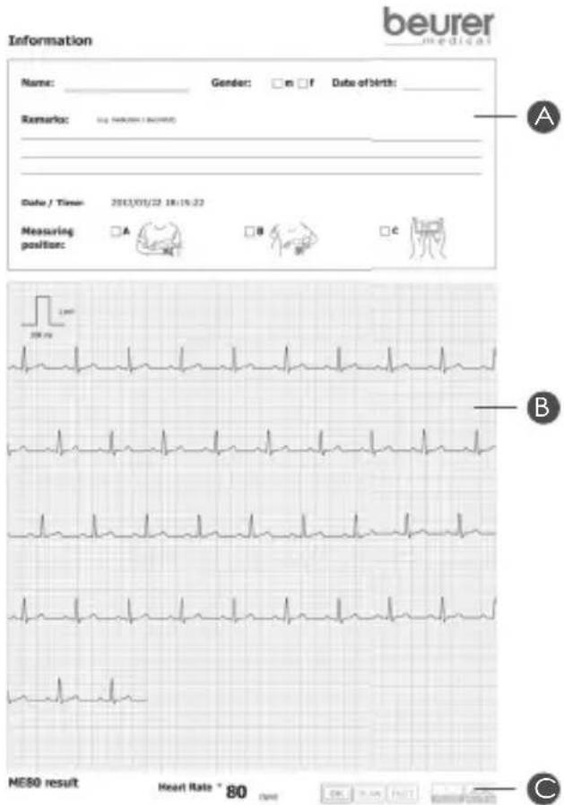 BEURER ME 80 - L'impression de votre ECG comprend les éléments suivants : - 4
