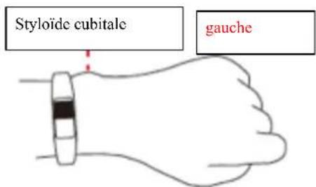 Styloïde cubitale gauche