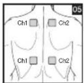 BEURER EM 44 - Positioning the Electrodes - 5
