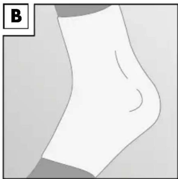 Sensiplast IAN 274662 - Applying the brace - 2
