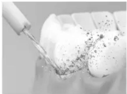 PANASONIC EWDJ11 - Limpieza de las bolsas periodontales - 1