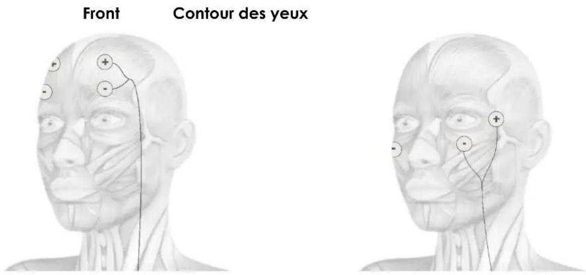 TensCare Uniglo - POSITIONNEMENT DES ELECTRODES - 3