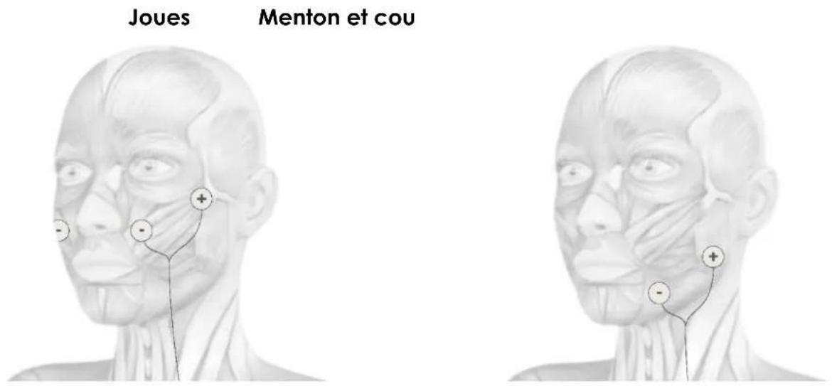 TensCare Uniglo - POSITIONNEMENT DES ELECTRODES - 4