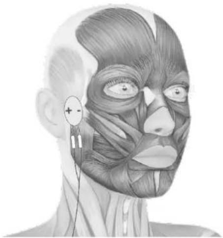 TensCare Uniglo - ELECTRODE PLACEMENT - 3