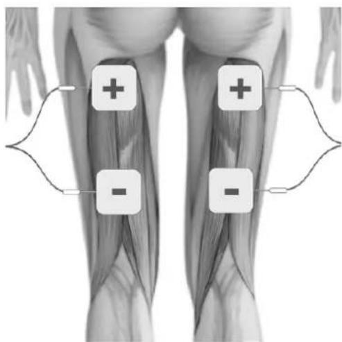 TensCare Uniglo - ELECTRODE PLACEMENT - 10