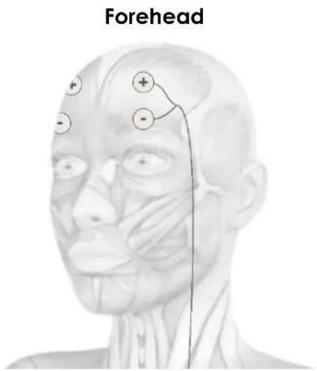 TensCare Uniglo - ELECTRODE PLACEMENT - 4