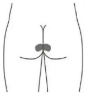 TensCare Perfect PFE - Optional skin surface electrode placement for STRESS (this may not be as effective as the stimulation with the vaginal probe) - 1