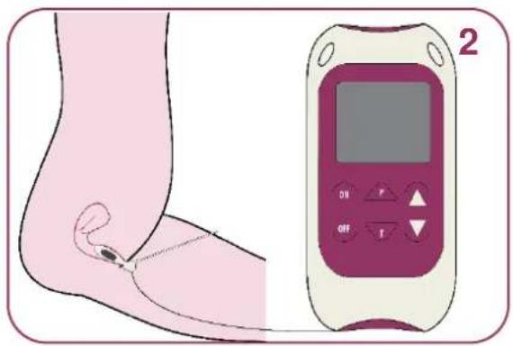 TensCare Perfect PFE - 3