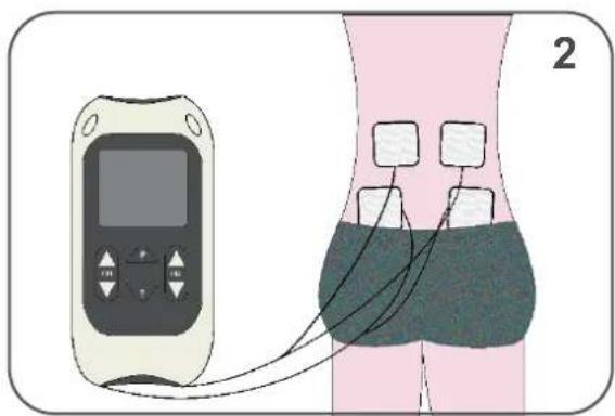 TensCare Perfect EMS - 1