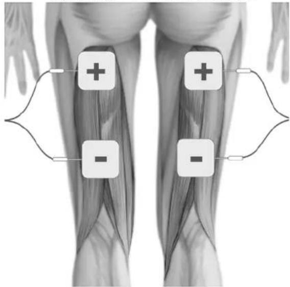 TensCare Perfect EMS - POSITIONNEMENT DES ELECTRODES POUR EMS - 5