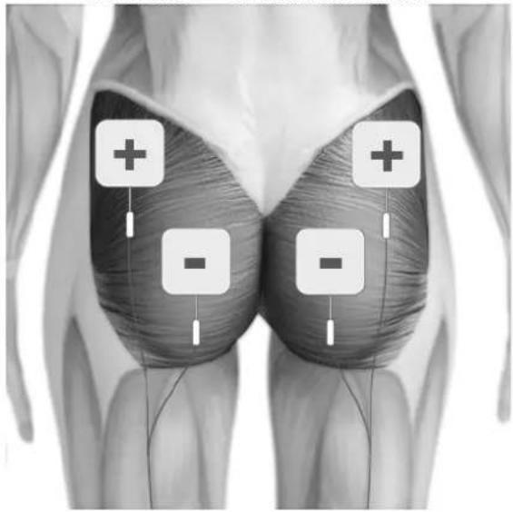 TensCare Perfect EMS - POSITIONNEMENT DES ELECTRODES POUR EMS - 4