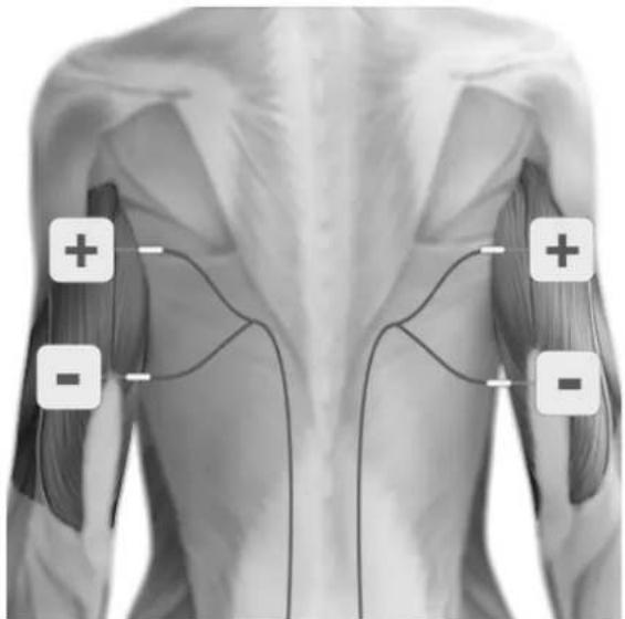 TensCare Perfect EMS - POSITIONNEMENT DES ELECTRODES POUR EMS - 7