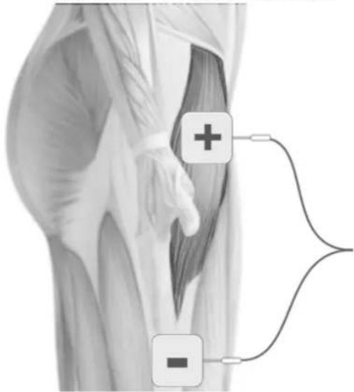 TensCare Perfect EMS - POSITIONNEMENT DES ELECTRODES POUR EMS - 6