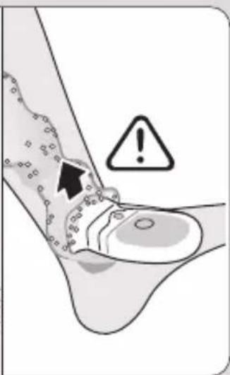 Medical diagram showing a foot with an arrow pointing to a specific area, accompanied by a warning symbol and an exclamation mark.