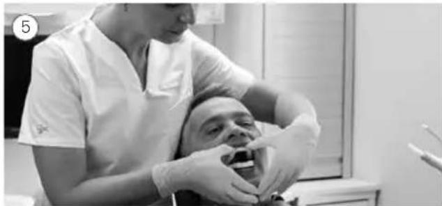 ResMed Narval CC - Applicazione dell'apparecchio - 5