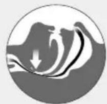 ResMed Narval CC - Indikationen - 4
