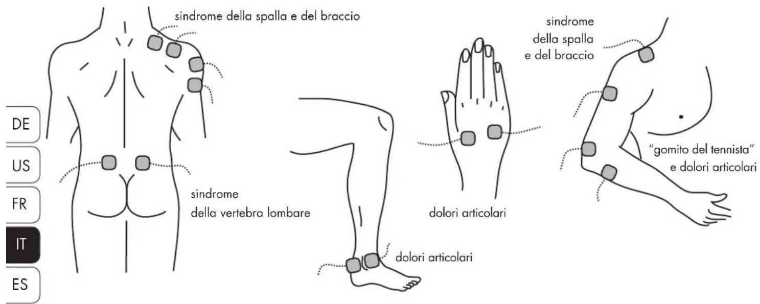 Promed Tens 1000 s - Collocazione degli elettrodi - 1