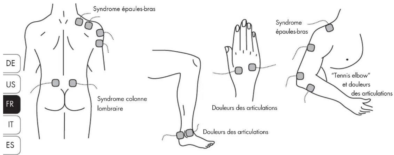 Syndrome épaules-bras Syndrome colonne lombraire Douleurs des articulations Douleurs des articulations Syndrome épaules-bras "Tennis elbow" et douleurs des articulations