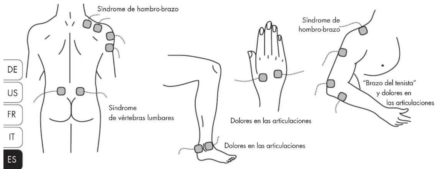 Promed Tens 1000 s - COLOCACIÓN DE LOS ELECTRODOS - 1