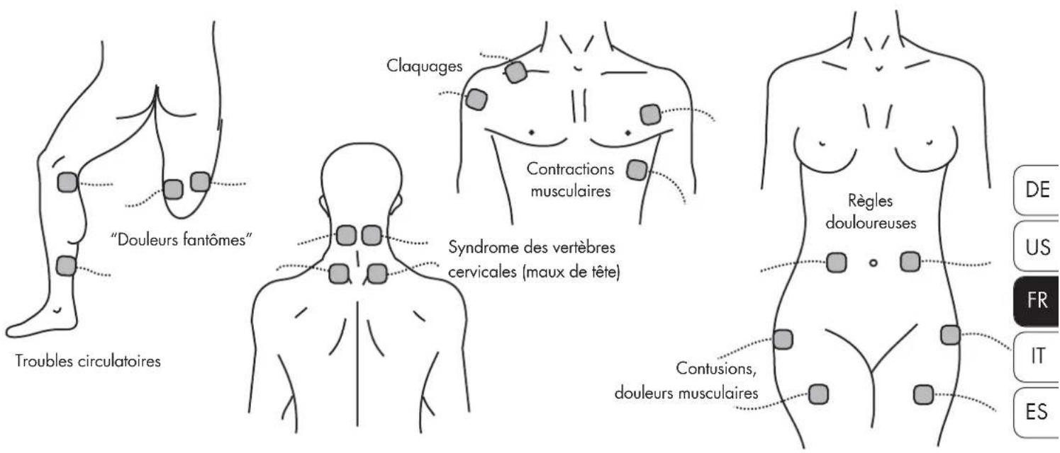 "Douleurs fantômes" Troubles circulatoires Claquages Contractions musculaires Syndrome des vertèbres cervicales (maux de tête) Règles douloureuses Contusions, douleurs musculaires DE US FR IT ES