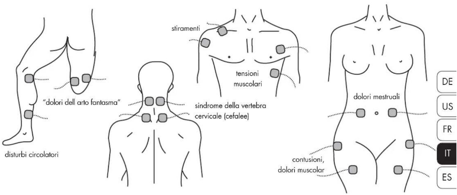 Promed Tens 1000 s - Collocazione degli elettrodi - 1