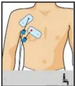 COMPEX One - Dessiner mes pecs - 1