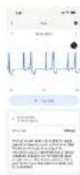 WITHINGS ScanWatch Nova - ECG Outputs - 14