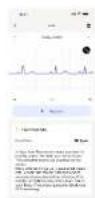 WITHINGS ScanWatch Nova - ECG Outputs - 4