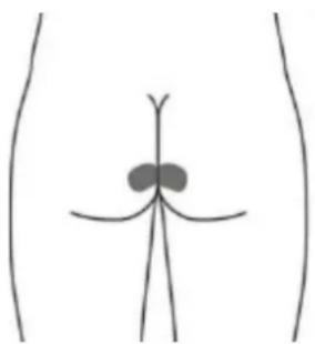 TensCare Elise 2 - Optional skin surface electrode placement for URGE (this may not be as effective as the stimulation with the vaginal probe) - 4