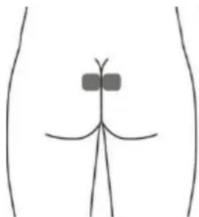 TensCare Elise 2 - Electrodo para la piel opcional para URGE (Esto puede no ser tan efectivo como la estimulación con la sonda vaginal) - 1