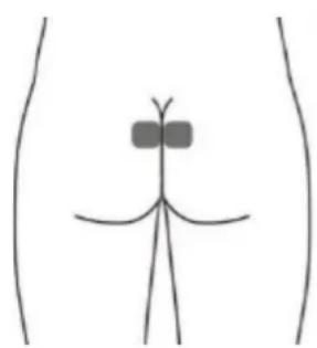 TensCare Elise 2 - Optional skin surface electrode placement for URGE (this may not be as effective as the stimulation with the vaginal probe) - 1