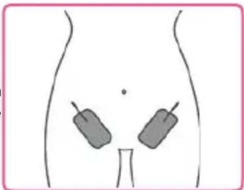 TensCare Ova - On the lower back: - 4