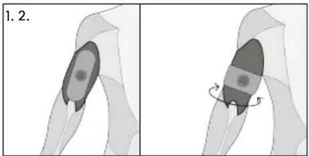 TensCare Form - Triceps - 1