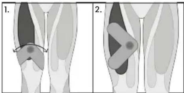 TensCare Form - Triceps - 12