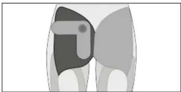 TensCare Form - Triceps - 10