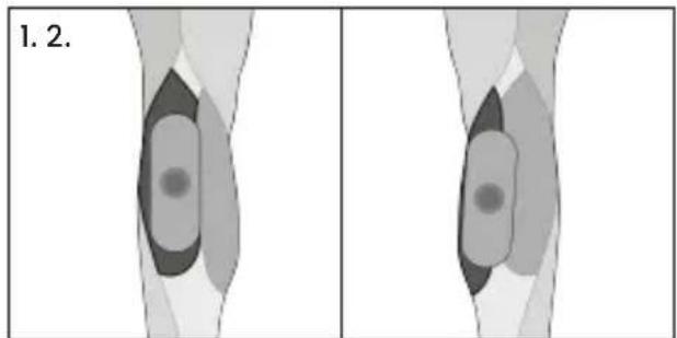 TensCare Form - Triceps - 6