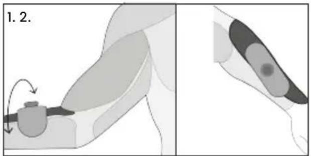TensCare Form - Tríceps - 2