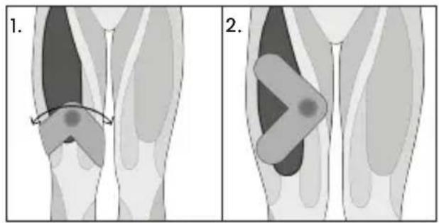 TensCare Form - Tríceps - 22