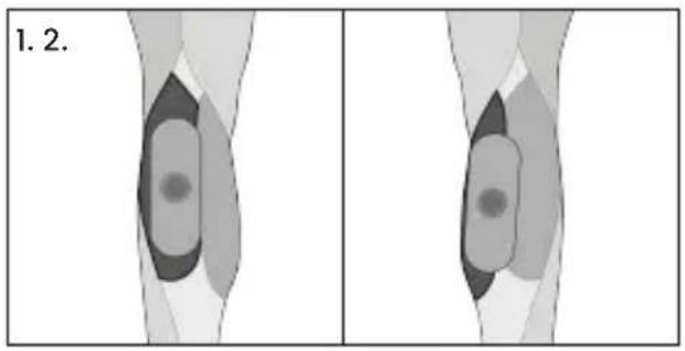 TensCare Form - Dépannage - 5
