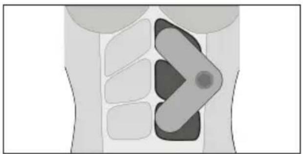 TensCare Form - Tríceps - 23