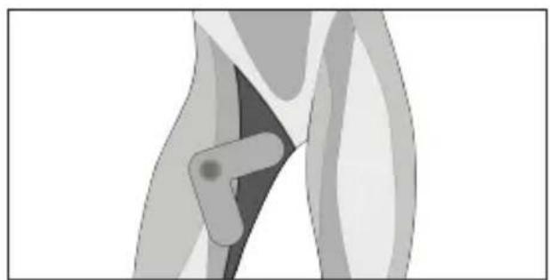 TensCare Form - Triceps - 11